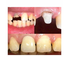 Artificial teeth restoration