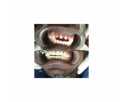 Artificial teeth replacement