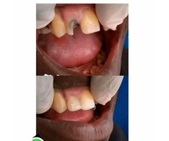 Teeth smile makeover